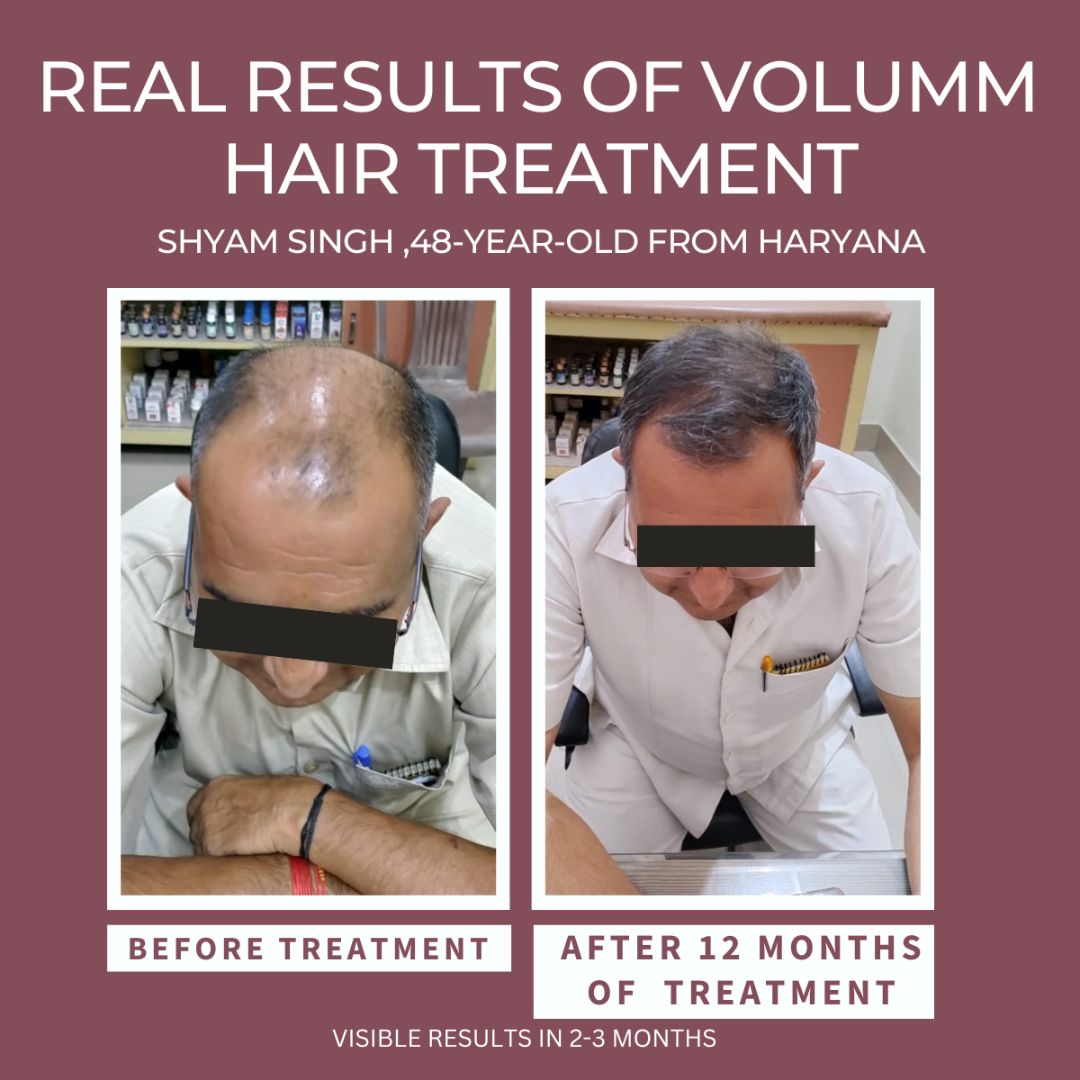 VOLUMM HAIR REGROWTH TREATMENT (FOR MEN) Razorveda