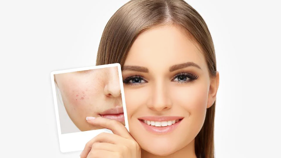How To Get Rid Of Acne Scars + How Long Does It Take To Fade