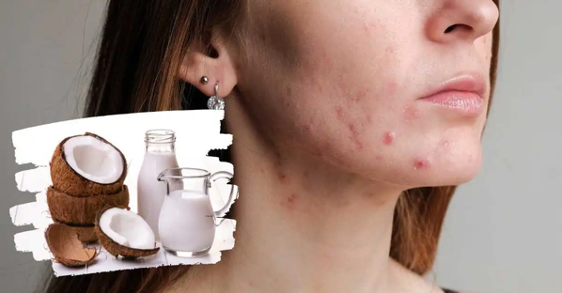 Coconut Oil On Acne: Does It Cure Or Worsen The Condition?