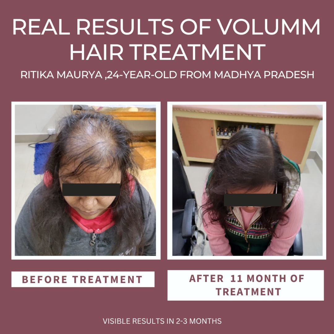 VOLUMM Hair Regrowth Treatment (For Women) Razorveda