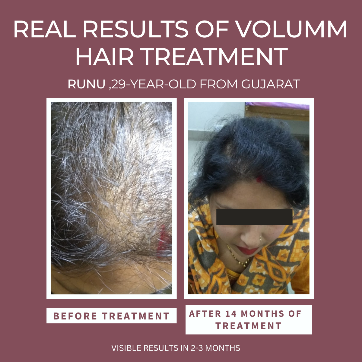 VOLUMM Hair Regrowth Treatment (For Women) Razorveda