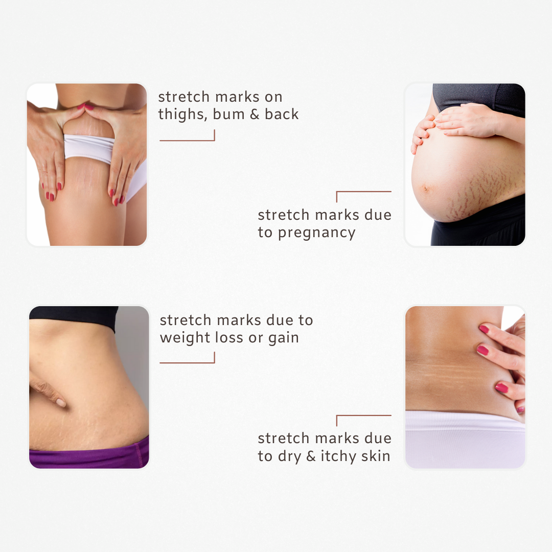 SIMLAR Anti-Stretch Marks Gel for Belly, Thighs, Arms & Intimate Area Stretch Marks Razorveda