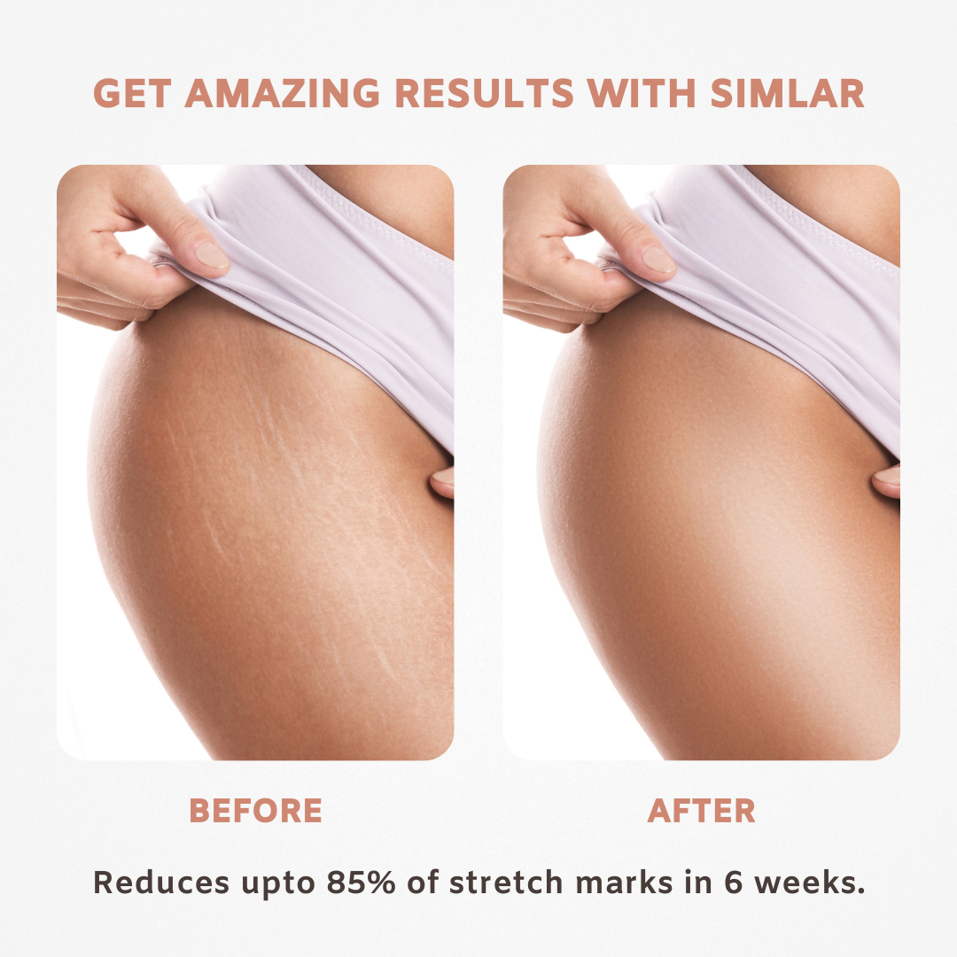 SIMLAR Anti-Stretch Marks Gel for Belly, Thighs, Arms & Intimate Area Stretch Marks Razorveda