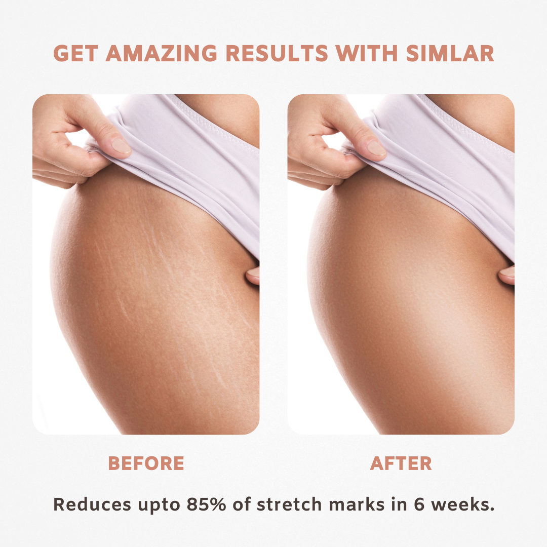 SIMLAR Anti-Stretch Marks Gel for Intimate Area Stretch Marks Razorveda